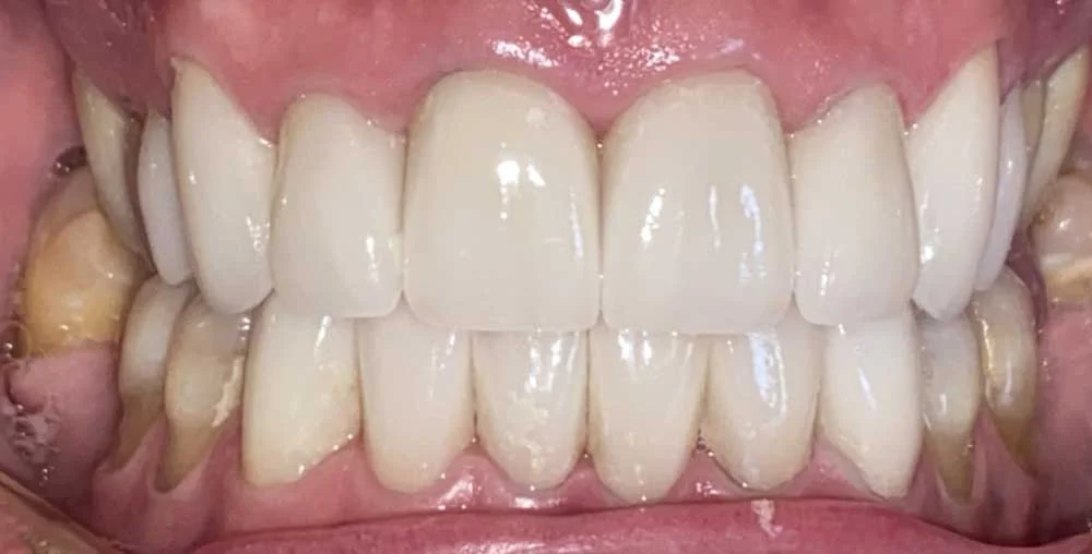 Patient smile after cosmetic treatment, case 1