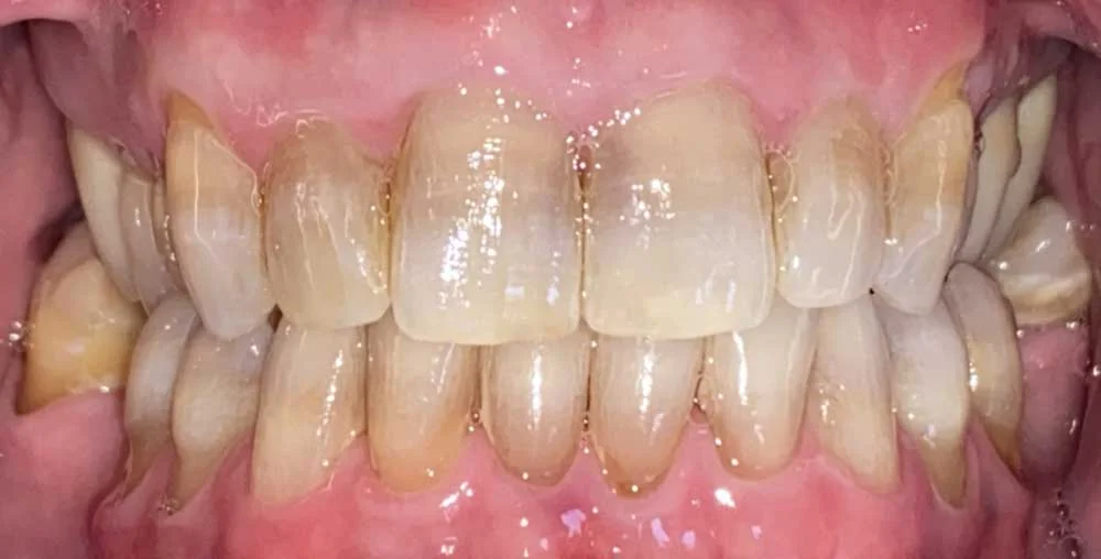 Patient smile before cosmetic treatment, case 1