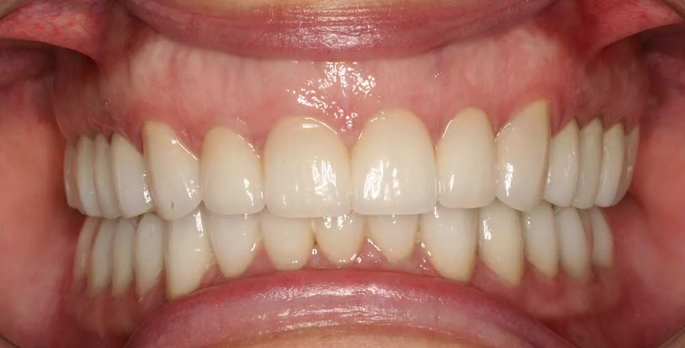Patient smile after cosmetic treatment, case 2
