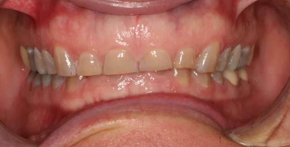 Patient smile before cosmetic treatment, case 2